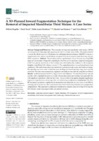 A 3D-Planned Inward Fragmentation Technique for the Removal of Impacted Mandibular Third Molars: A Case Series